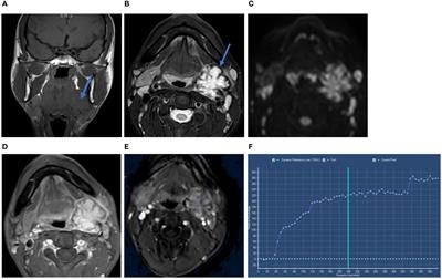 Intranodal palisaded myofibroblastoma in the submandibular gland region: a case report